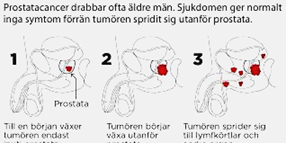 aggressiv prostatacancer symtom aggressiv prostatacancer symtom